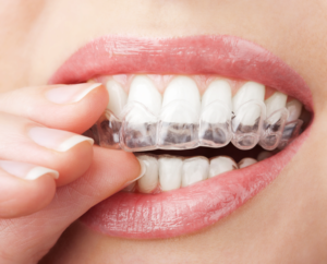 Coral Springs Braces | Parkland Braces | Coconut Creek Braces | Pompano Beach Braces | Types of Braces